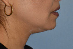 Double Chin Correction