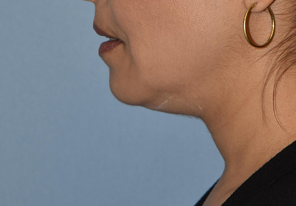 Double Chin Correction