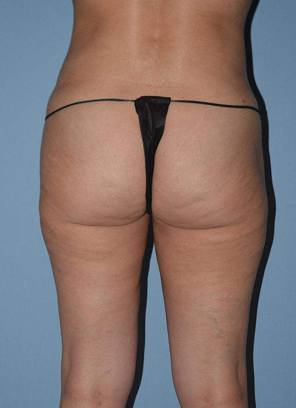 Liposuction