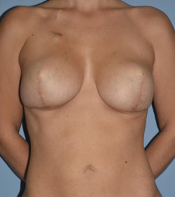 Breast Reconstruction (Implants)