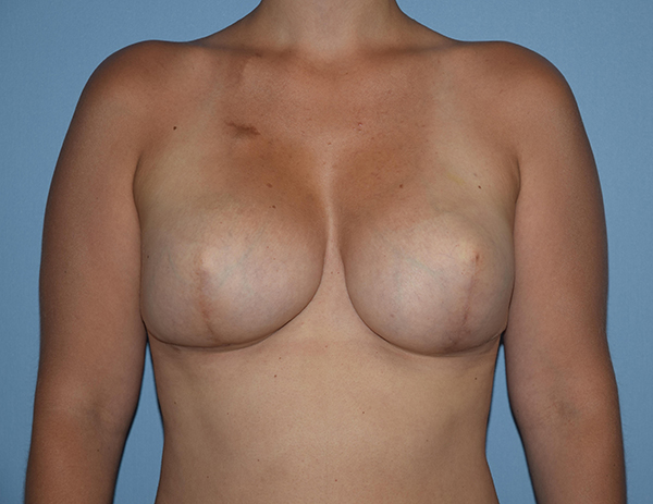 Breast Reconstruction (Implants)