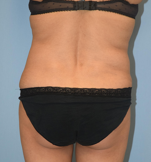 Liposuction