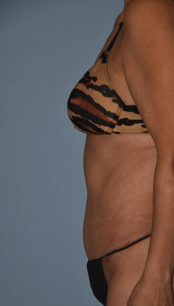 Tummy Tuck