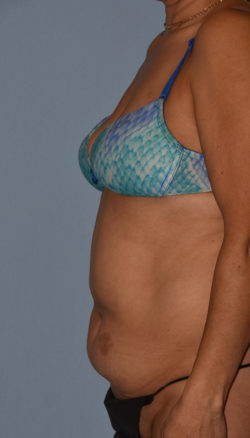 Tummy Tuck