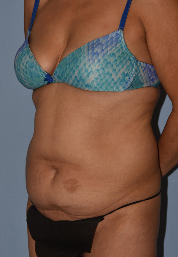 Tummy Tuck