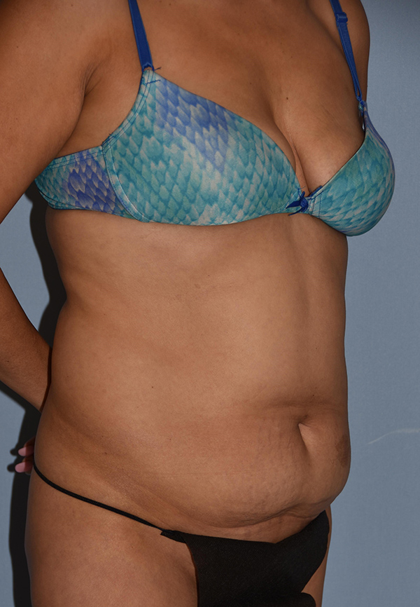 Tummy Tuck