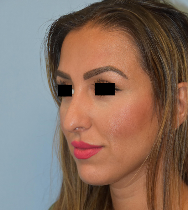 Rhinoplasty