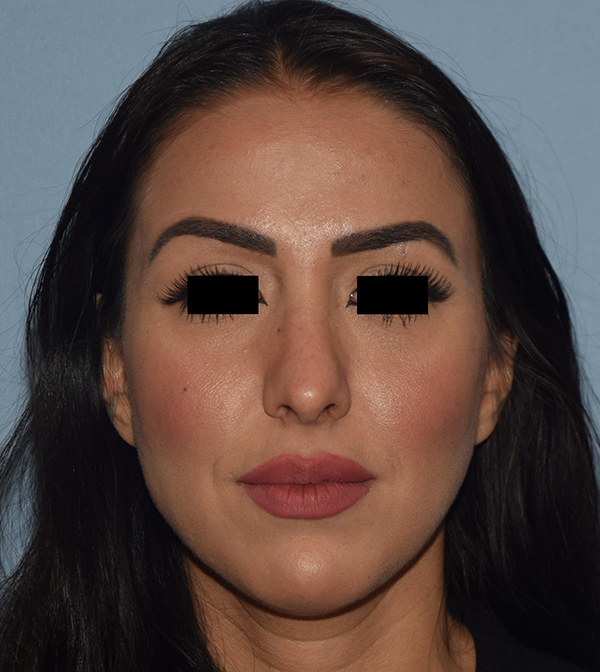 Rhinoplasty