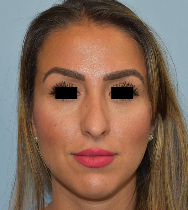 Rhinoplasty