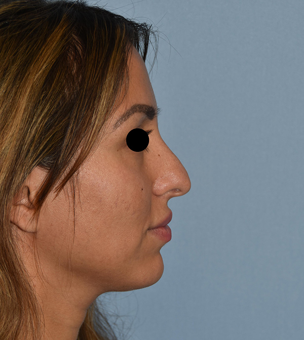 Rhinoplasty