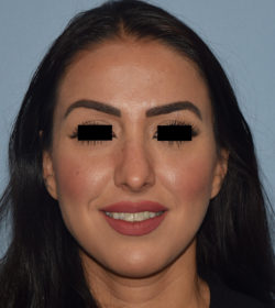 Rhinoplasty