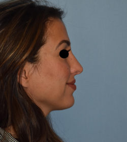 Rhinoplasty