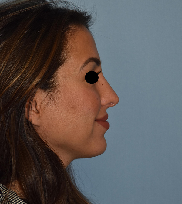 Rhinoplasty