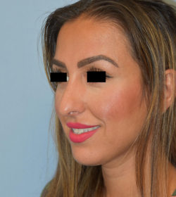 Rhinoplasty