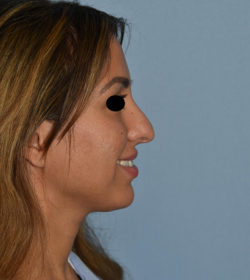 Rhinoplasty