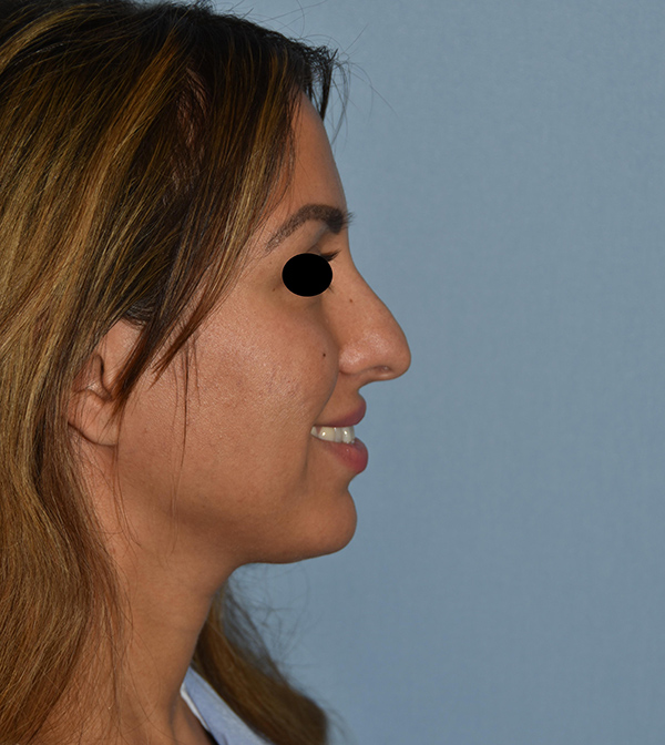 Rhinoplasty