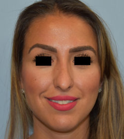 Rhinoplasty