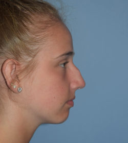 Rhinoplasty