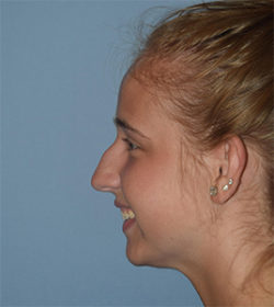 Rhinoplasty