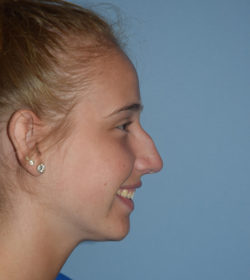 Rhinoplasty