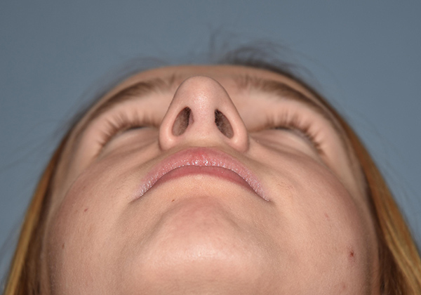 Rhinoplasty