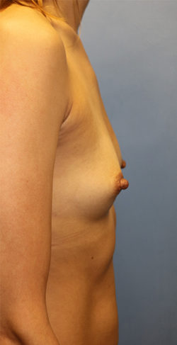 Breast Augmentation