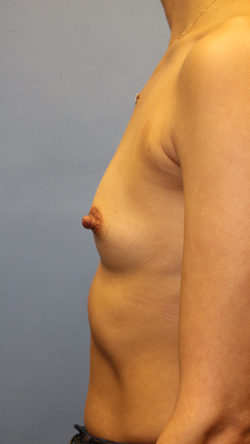 Breast Augmentation