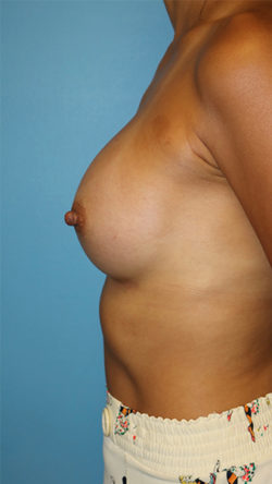 Breast Augmentation