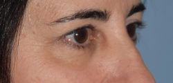 Upper Eyelid Blepharoplasty