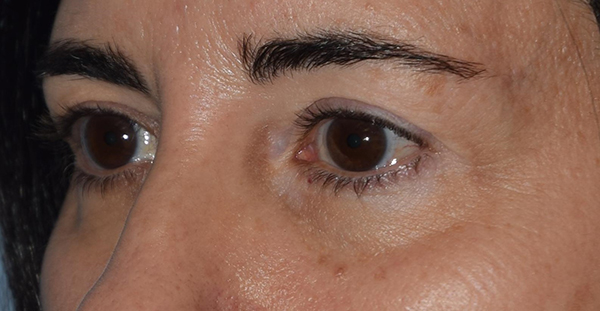 Upper Eyelid Blepharoplasty