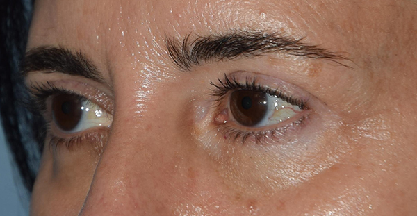 Upper Eyelid Blepharoplasty