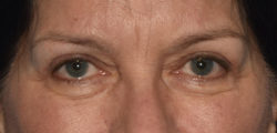 Upper Eyelid Blepharoplasty