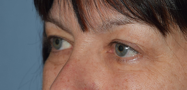 Upper Eyelid Blepharoplasty