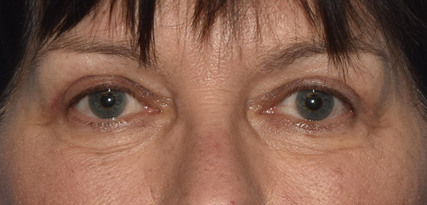 Upper Eyelid Blepharoplasty