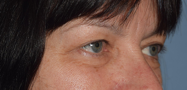 Upper Eyelid Blepharoplasty