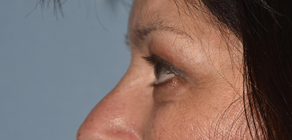 Upper Eyelid Blepharoplasty