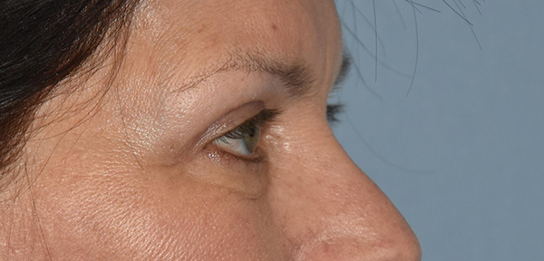 Upper Eyelid Blepharoplasty