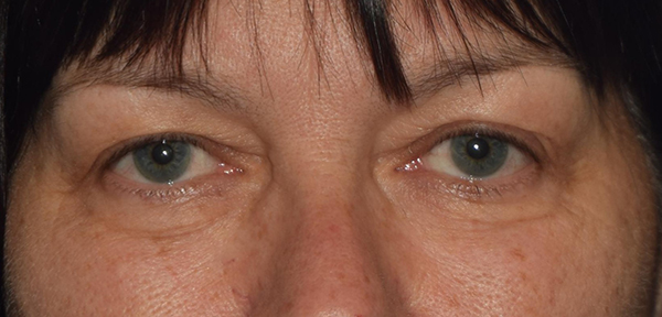 Upper Eyelid Blepharoplasty