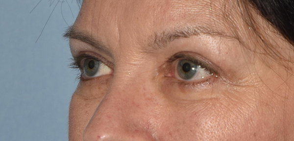 Upper Eyelid Blepharoplasty