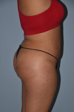 Liposuction