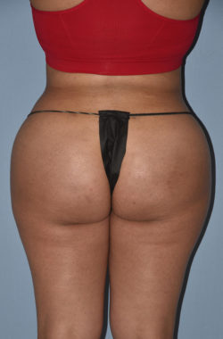 Liposuction