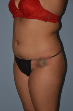 Liposuction