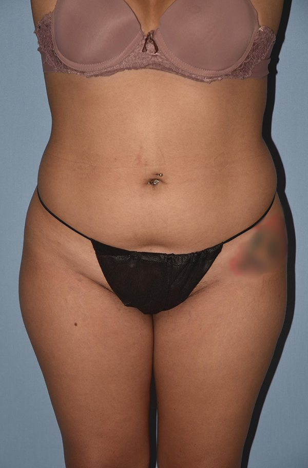 Liposuction