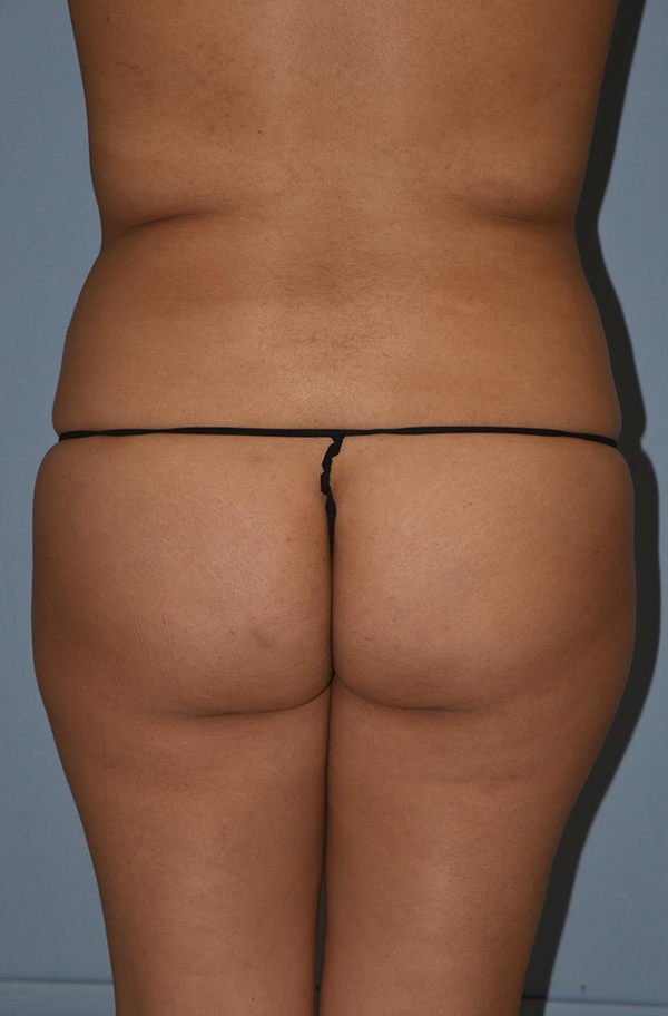 Liposuction