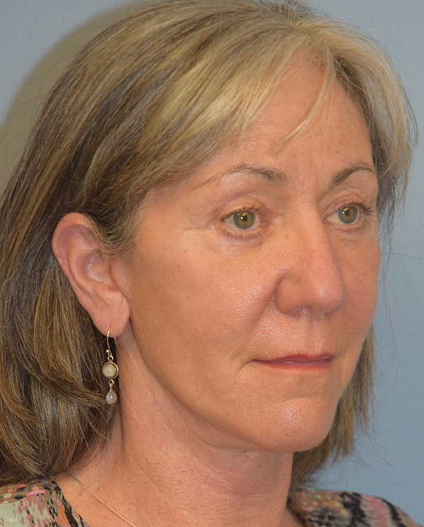 Facelift