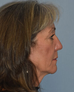 Facelift