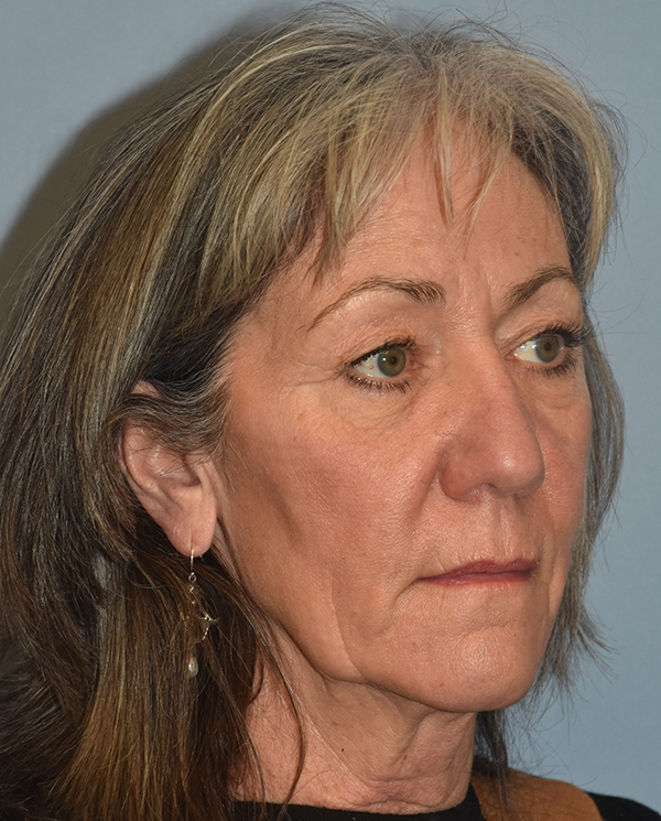 Facelift